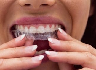 nakładka ortodontyczna